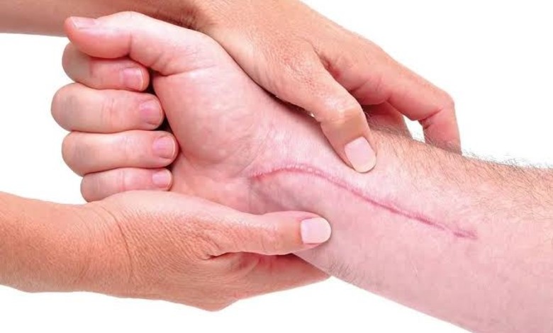 کدام محصول ترمیم رد بخیه را بخریم؟